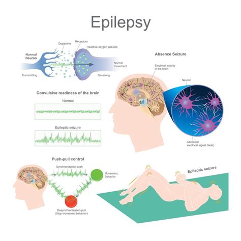 Epilepsy Facts Statistics And You Artofit