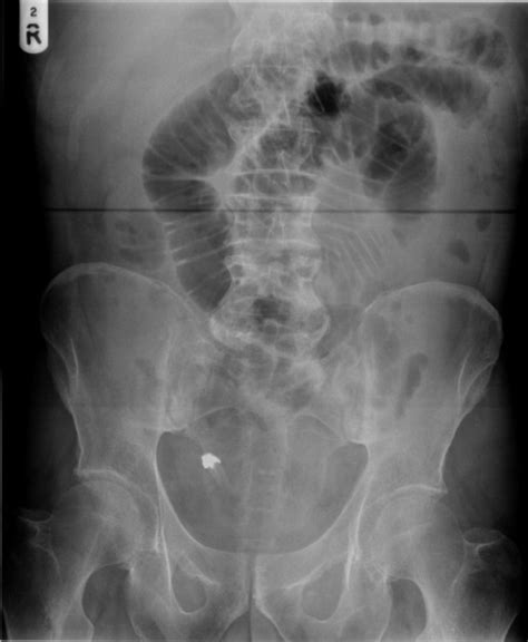 Abdominal X Ray Showing Denture Causing Small Bowel Obs Open I