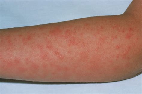 Derm Dx A Diffuse Erythematous Rash That Blanches With Pressure