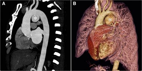 Saccular Aortic Arch Aneurysm In The Cardiovocal Syndrome Circulation