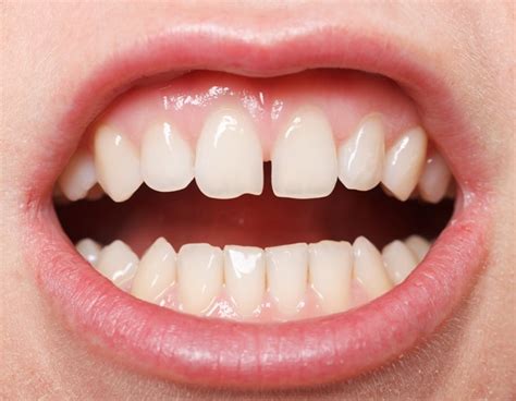 Teeth gaps can be fixed with different dental techniques. How to Fix Gap Between Front Teeth | Savina Dental Clinics ...