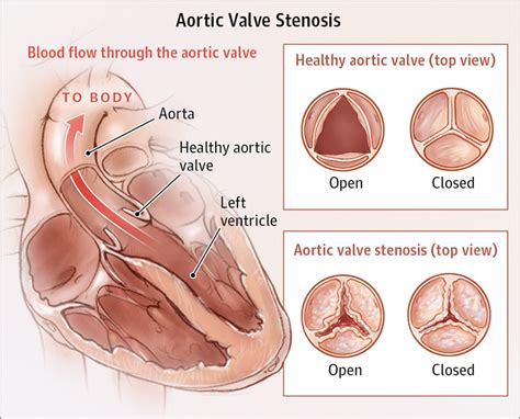 Aortic Valve Stenosis Valvular Heart Disease Jama Cardiology Jama Network