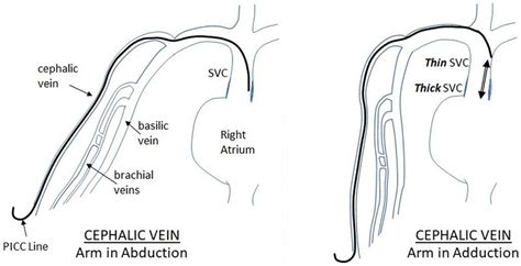 Displacement Of Picc Inserted Through The Cephalic Vein During Arm