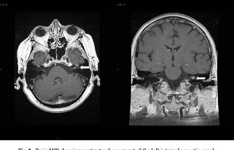 Ramsay Hunt Syndrome With Trochlear Nerve Involvement And Eeg