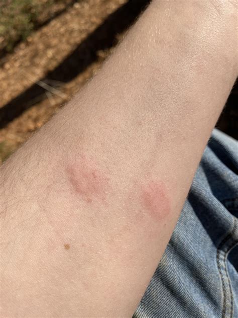 Two Itchy Red Welts On My Arm Any Clue What This Might Be Rmedical