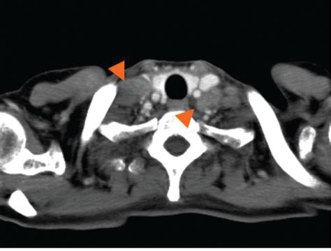 A Computed Tomography Scan Revealed The Swelling Of Multiple Lymph