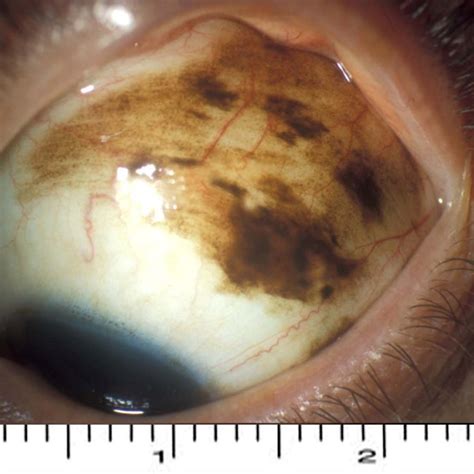 Conjunctival Melanoma In The Eye Ocumel Uk