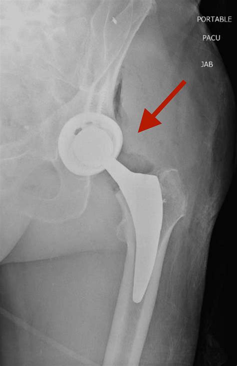 Near Complete Transection Of The Sciatic Nerve After Closed Reduction