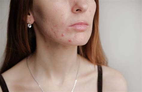 5 Things To Do To Help Your Acne Go Away For Good