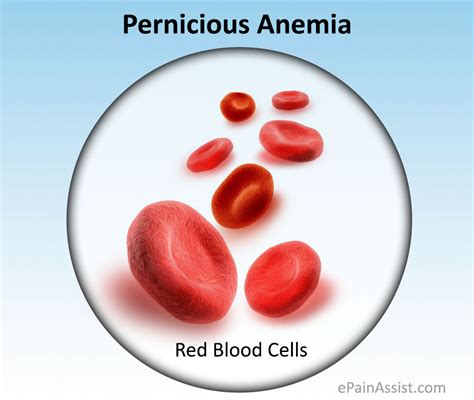 Pernicious Anemia Or Addisonbiermer Anemiacausesrisk Factors