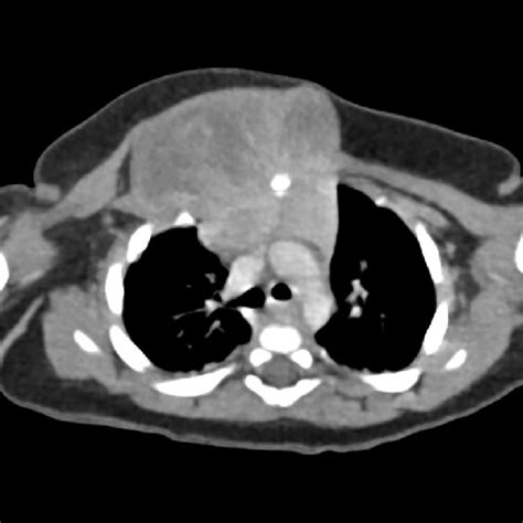Contrast Thoracic Ct Showing An Intra And Extrathoracic Component Mass