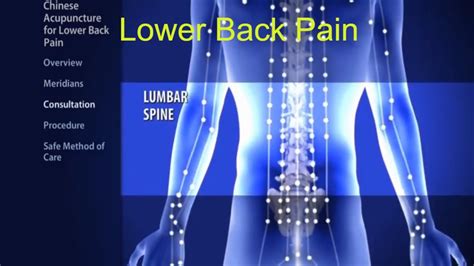 Lower Back Pain Treatment Acupuncture Youtube