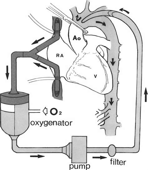 Ida Tiur Simanjuntak Cardiopulmonary Bypass And Cardioplegia