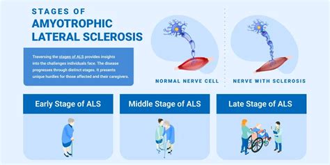 Als Stages Symptoms And Timeline