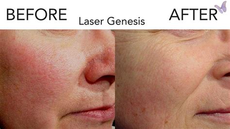Laser Genesis At Home Healthyhappylady