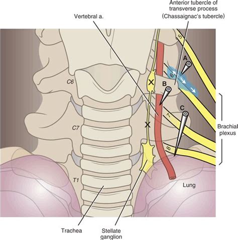 Complications Associated With Stellate Ganglion And Lumbar Sympathetic