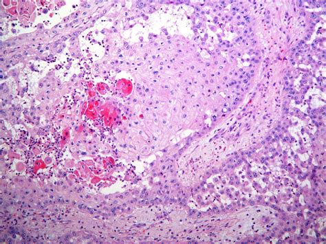 Pathology Outlines Squamous Cell Carcinoma Scc