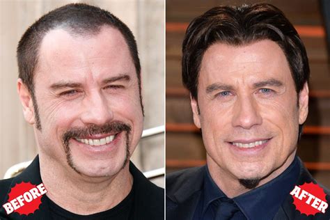 John Travolta Chirurgie Capillaire Hair Transplant Hair Cloning Celebrity Hairstyles