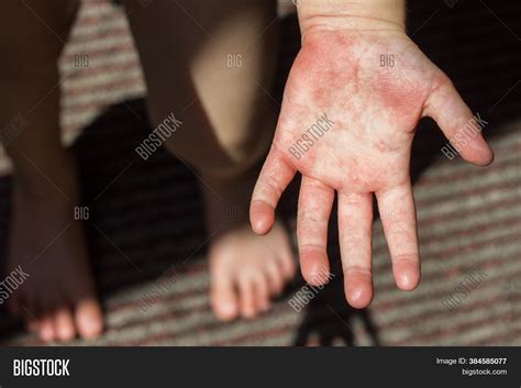 Red Rash On Hands Image And Photo Free Trial Bigstock
