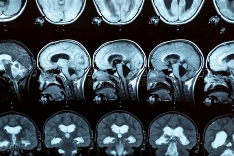 A Imagem De Ressonância Magnética Do Cérebro Mostrou Hidrocefalia Triventricular Obstrutiva Com