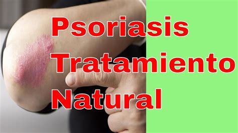 📌 Psoriasis Tratamiento Natural Youtube