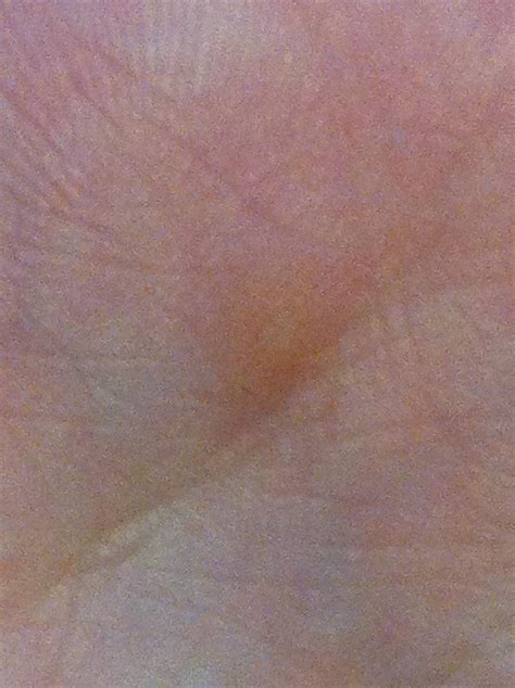 Small Bumps On My Hand Dermatology