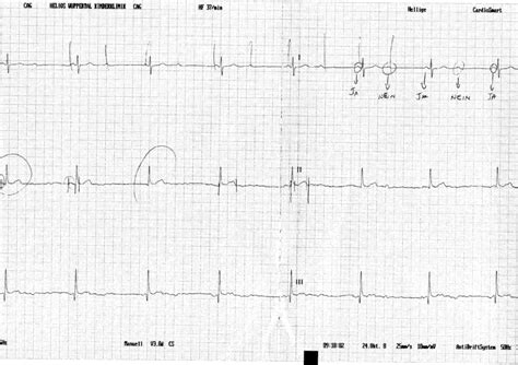 Ecg Showing Intermittent Heart Block Download Scientific Diagram