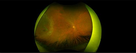 Retinal Tears Treatment Mid Atlantic Retina