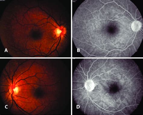 Retinography And Normal Retinal Fluorescein Angiogram Of The Right Eye