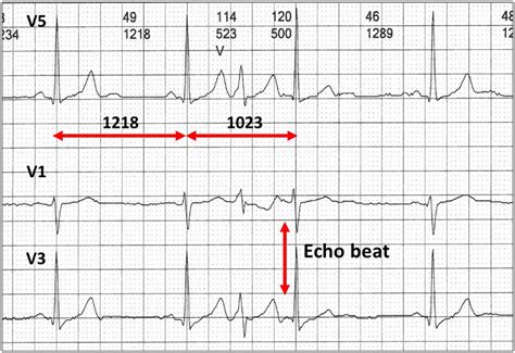 The Electrocardiographic Footprints Of Atrial Ectopy Heart Lung And