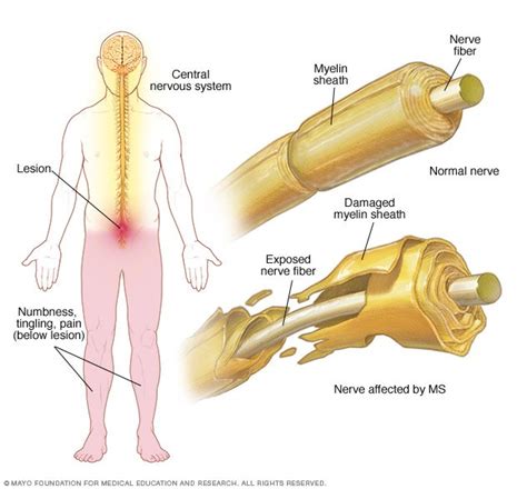Get important safety information for your patients with multiple sclerosis. Multiple sclerosis Disease Reference Guide - Drugs.com