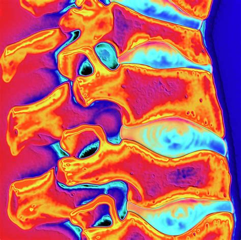 Coloured X Ray Of Human Spine With Osteoporosis Photograph By Alfred