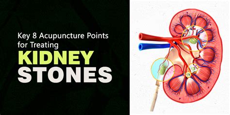 8 Potent Acupuncture Points For Treating Kidney Stones