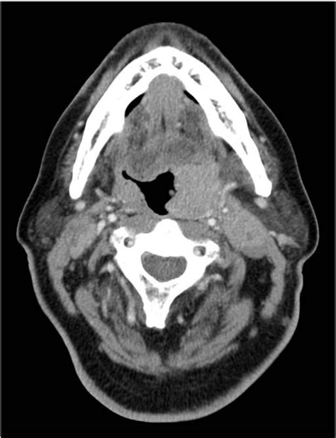 Squamous Cell Carcinoma Of The Tonsil Masquerading As A Peritonsillar Abscess Ajem