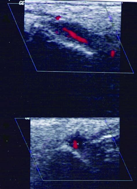 Colour Duplex Sonography Of Temporal Arteries Before Decision For