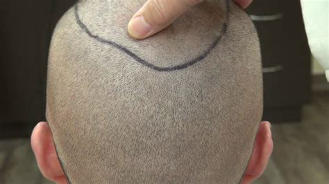 Fue Donor Scar Hair Transplant Surgery Scalp Scars By Dr Diep Bald