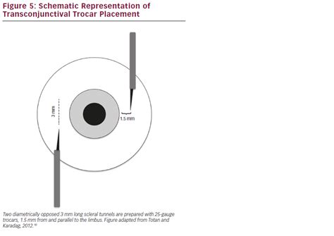 Microincision Vitrectomy Trocars Redefining Surgical Practices