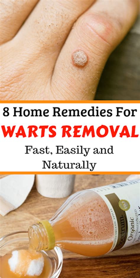 8 Home Remedies For Warts Removal Fast Easily And Naturally Home