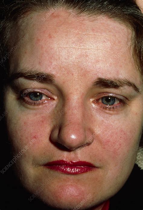 Facial Rash Of Systemic Lupus Erythematosus Sle Stock Image M200