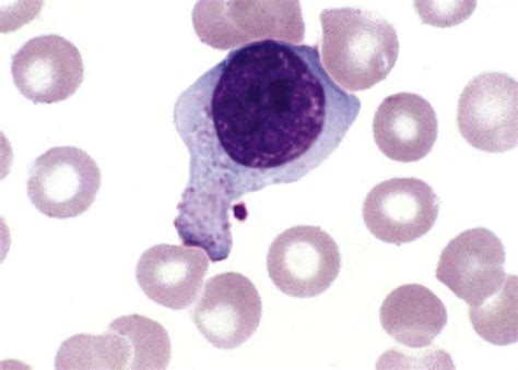 Nonmalignant Leukocyte Disorders Oncohema Key