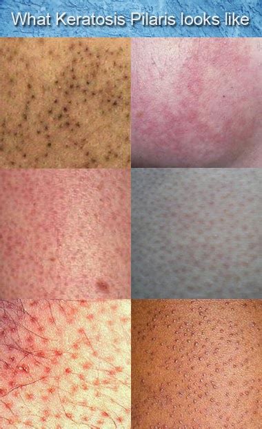Rough Bumps Skin Dorothee Padraig South West Skin Health Care