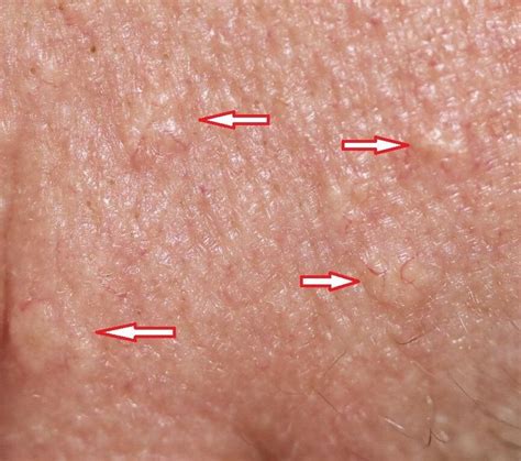 bumpy skin sebaceous hyperplasia and electrocautery by deborah tosline — skin remodeling diy