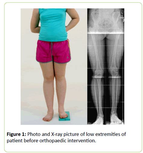 Lengthening Of Femur By Combined Osteosynthesis A Case Report