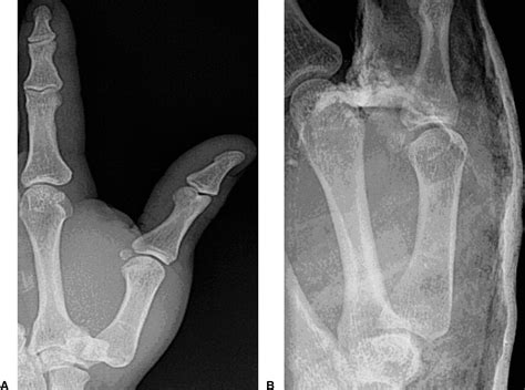 Traumatic Thumb Carpometacarpal Joint Dislocations Journal Of Hand