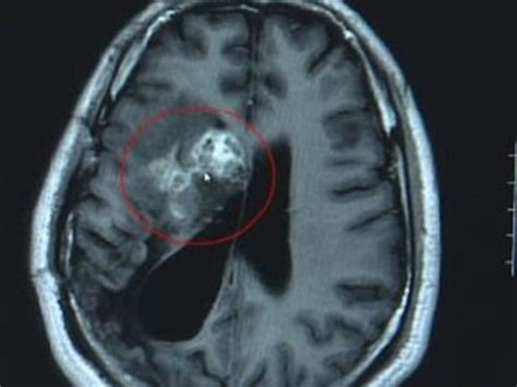 Tapeworm 12cm Ate At Chinese Mans Brain For 15 Years Au