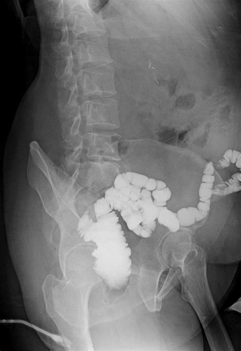 Top 50 Year Old Female With Crohns Disease Plain X Ray Lateral