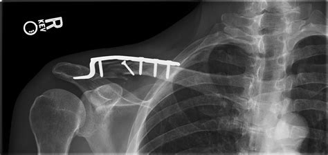 Distal Third Clavicle Fractures Trauma Orthobullets