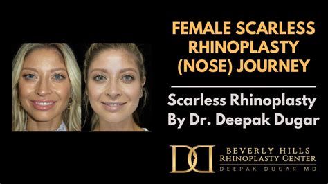 Female Scarless Rhinoplasty Nose Journey Day With Dr Deepak Dugar Beverly Hills Youtube