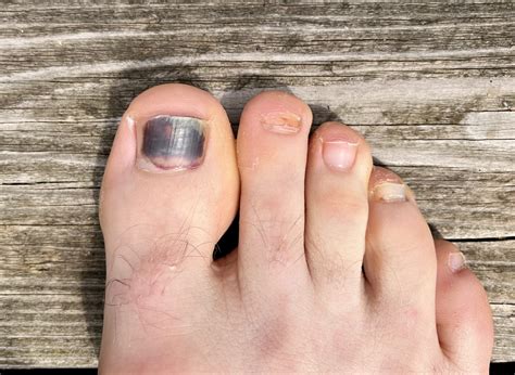 Black Toenail Causes Treatment And Prevention Tips Feet First Clinic