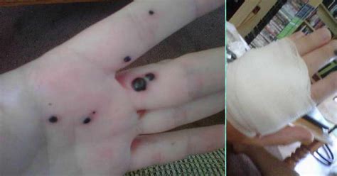 Husband Noticed Mysterious Black Spots On Wifes Hand What Happened